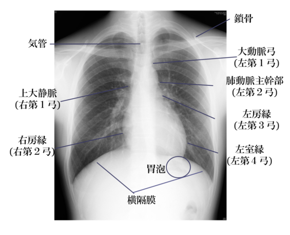 胸部 レントゲン 写真 の 見方